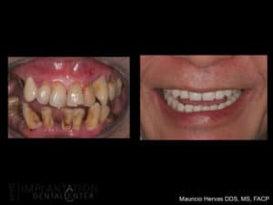 Missing Teeth - Before and After Dental Implants - Dr. Hervas