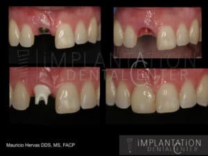 Plantation, Florida Dental Implant Specialist Dr. Mauricio Hervas