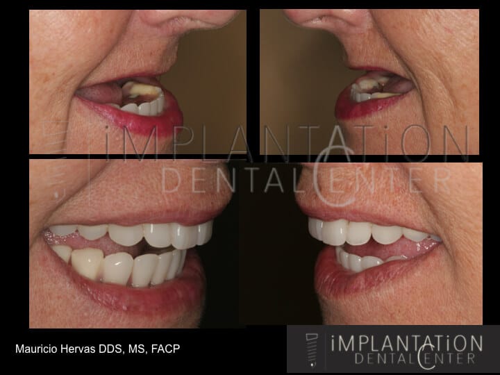 Fort Lauderdale Dentist · Implantation Dental Center