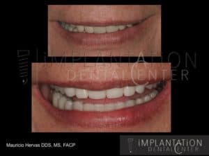 Plantation, Florida Dental Implant Specialist Dr. Mauricio Hervas