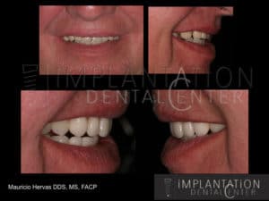 Plantation, Florida Dental Implant Specialist Dr. Mauricio Hervas