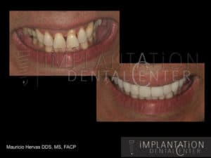 Plantation, Florida Dental Implant Specialist Dr. Mauricio Hervas