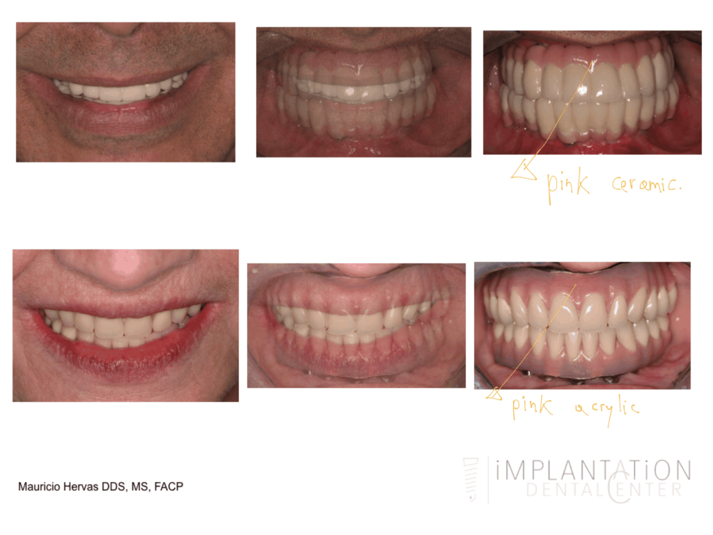 Invisalign Dentist in Plantation, FL and Coral Gables, FL