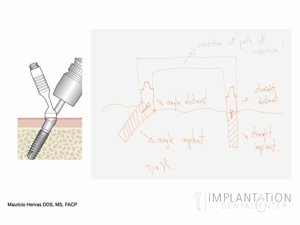 Plantation, Florida Dental Implant Specialist Dr. Mauricio Hervas