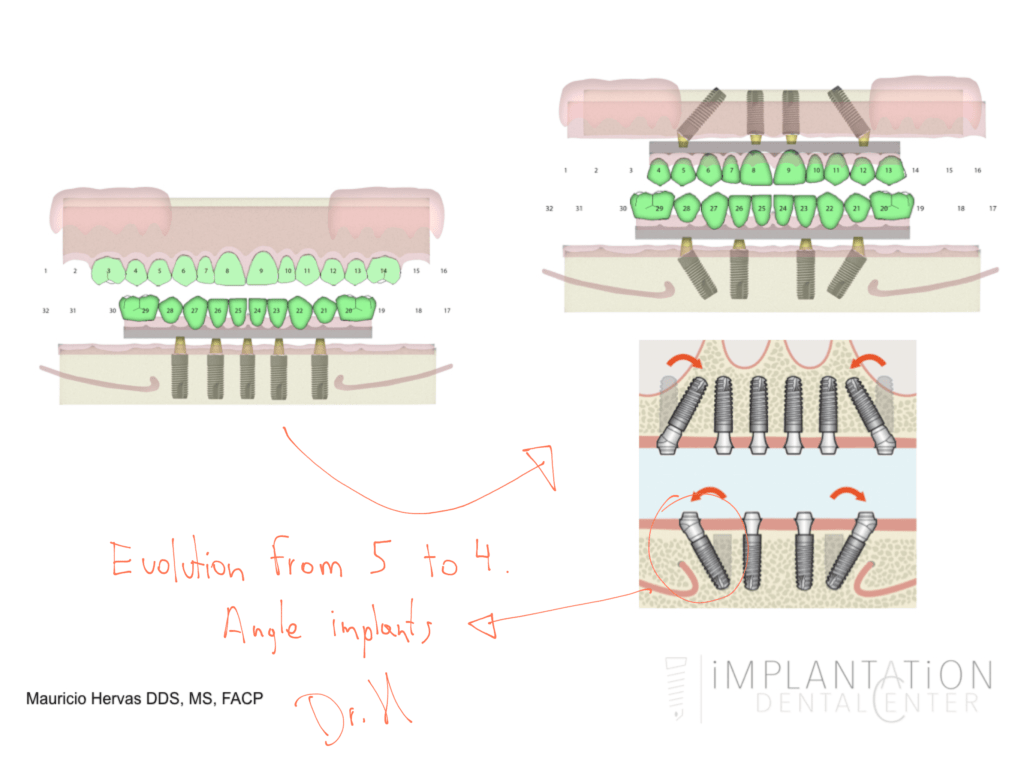 Plantation, Florida Dental Implant Specialist Dr. Mauricio Hervas