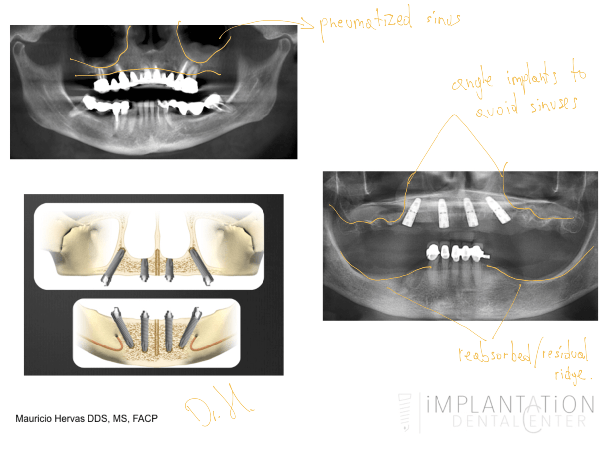 Plantation, Florida Dental Implant Specialist Dr. Mauricio Hervas