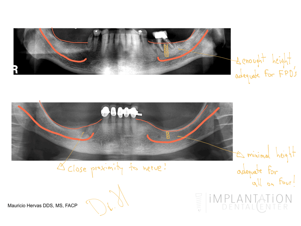 Plantation, Florida Dental Implant Specialist Dr. Mauricio Hervas