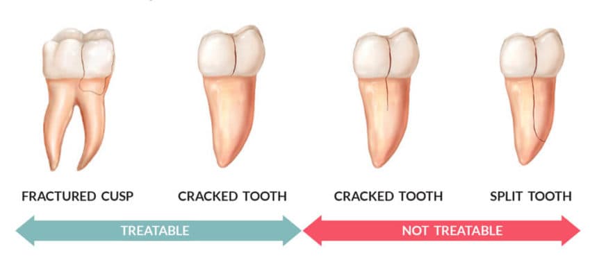 Fix a Cracked Tooth - Call our Fort Lauderdale Dental Office 954-476-0770