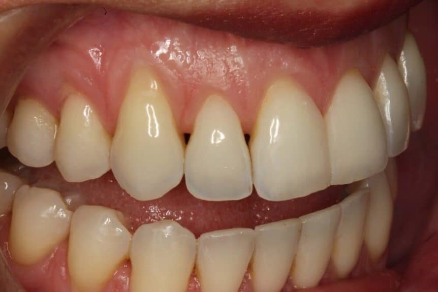 Black triangles dark spaces between your teeth dentist blog
