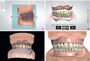 Digital Dentures Implantation Dental Center