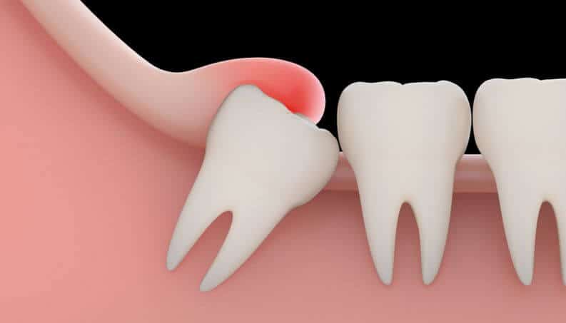 wisdom tooth removal plantation and fort lauderdale florida