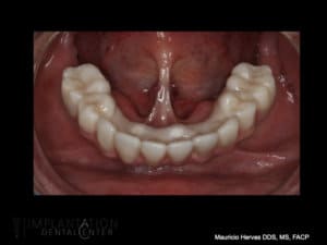 Screw retained lower hybrid prosthesis. Zirconia. All on four