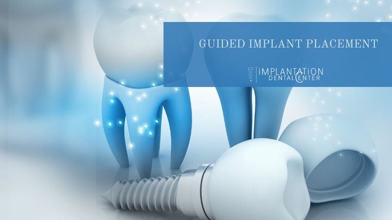 Guided implant placement