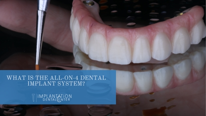 What is all-on-four dental implant system?