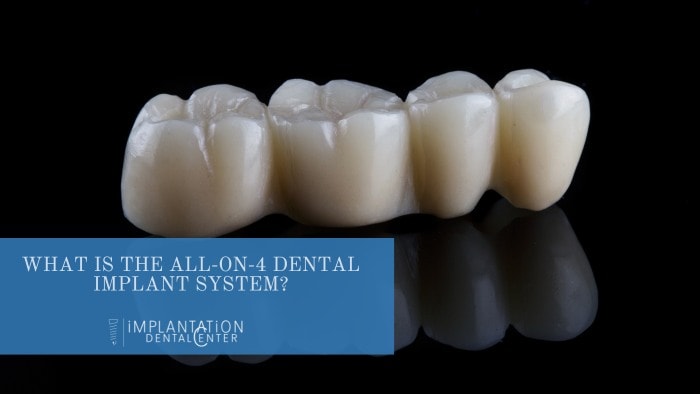 What is all-on-four · Implantation Dental Center