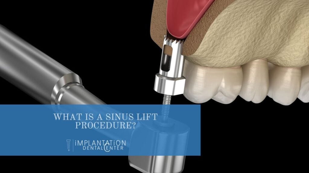 sinus lift procedure plantation Florida