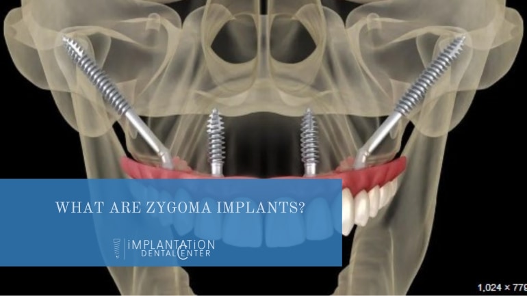 zygoma implant placement inside the mouth