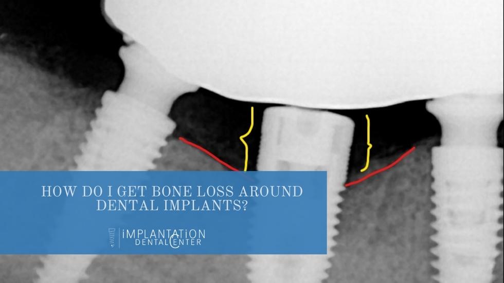 bone loss around dental implants