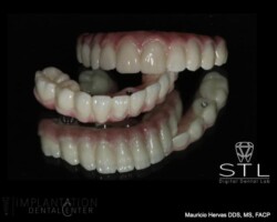 Upper and lower screw retained zirconia
