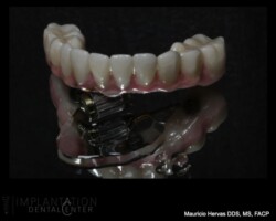 Lower zirconia prosthesis