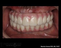 Upper and lower introaral pictures. Zirconia prosthesis
