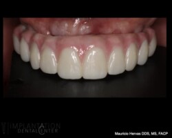 Upper zirconia prosthesis