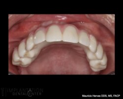 Upper zirconia prosthesis. No palate
