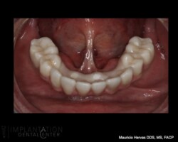 Screw retained lower hybrid prosthesis. Zirconia. All on four