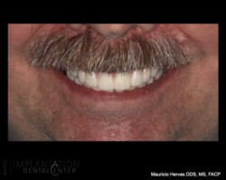 Natural esthetics. Zirconia prosthesis