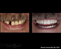 Before and after. All on 4