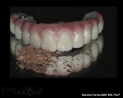 Full zirconia restoration