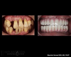 Before and after. Zirconia proshesis