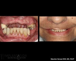 Before treatment. Lip deficiency