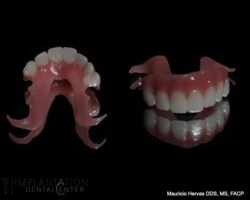 PMMA prototype