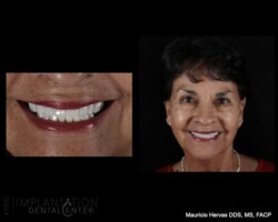 All on four. Esthetically pleasant smile