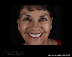 Hollywood smile. Beautiful restoration