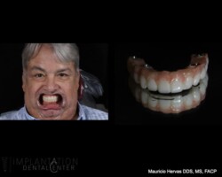 PMMA try in