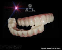 Upper and lower monolithic restorations