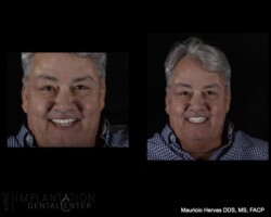 Perfect smile. Very natural outcome