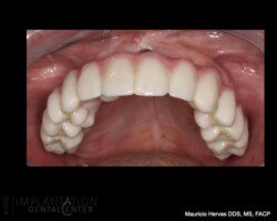 Upper hybrid zirconia prosthesis