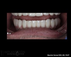 Lower plane of occlusion in zirconia