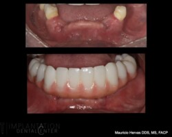 Lower PMMA prototype