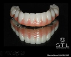 Lower PMMA prototype
