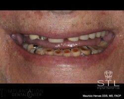 Worn out dentition