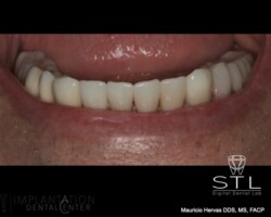 New lower zirconia teeth