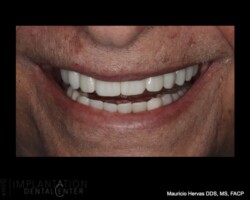 New full mouth rehabilitation