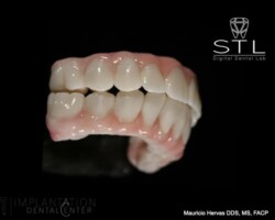 Upper and lower full mouth rehabilitation in zirconia