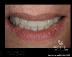 Upper and lower all on four. Esthetic result