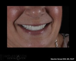 Pleasant smile. Full upper zirconia