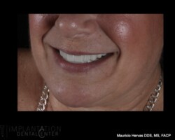 Highly esthetic restoration. Hybrid prosthesis